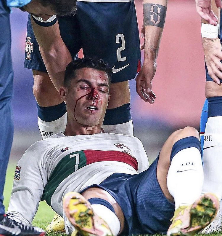 Scary Injury To Ronaldo For Portugal, Thankfully He Managed To Carry On Playing